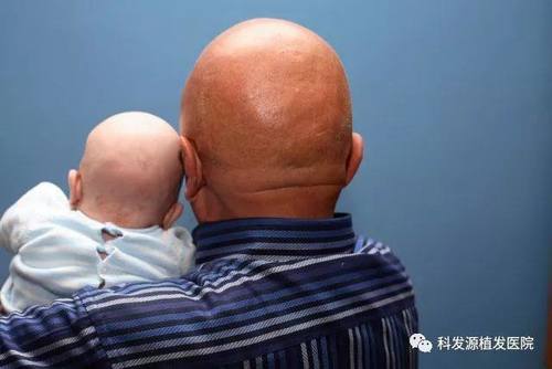 脱发儿童植发手术有年龄限制吗？