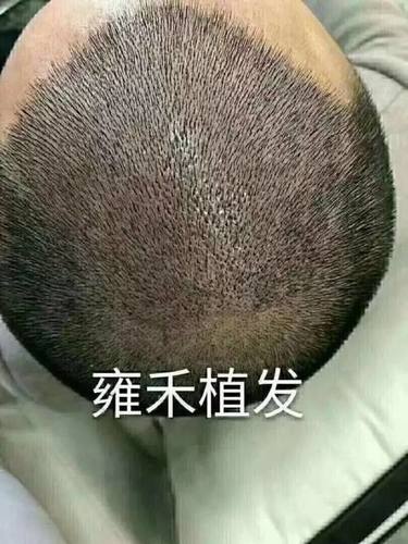 植发到底靠谱吗？为什么不去植发