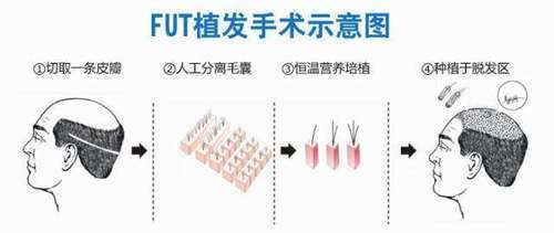 植发可能会有后遗症该怎样避免？