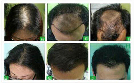 “新生TDDP毛发种植体系”快速处理头发稀少问题