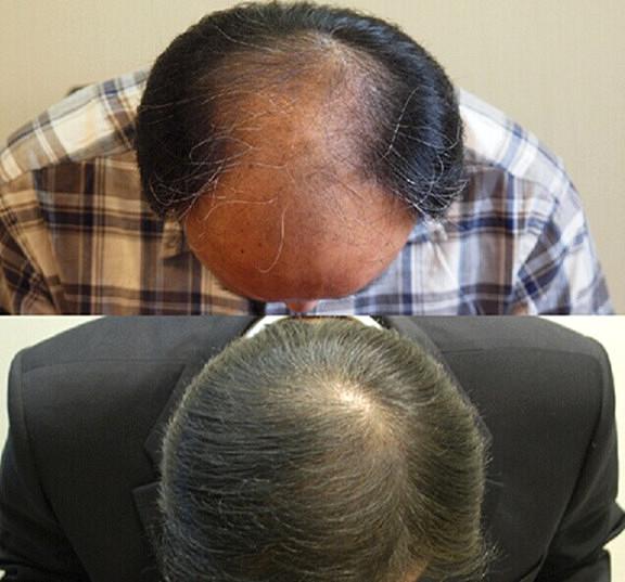 南京头发移植后的恢复时间需要多长？