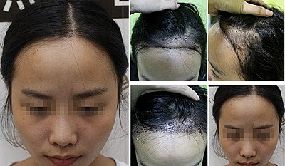 南京种植头发后多久可以恢复？
