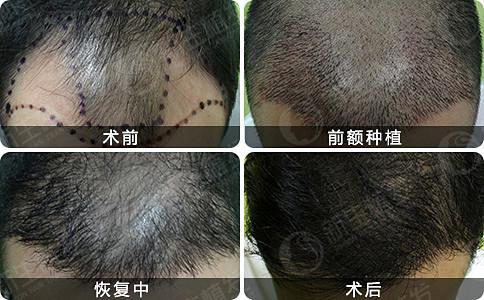 在南京种植完头发后能达到什么样植发效果？