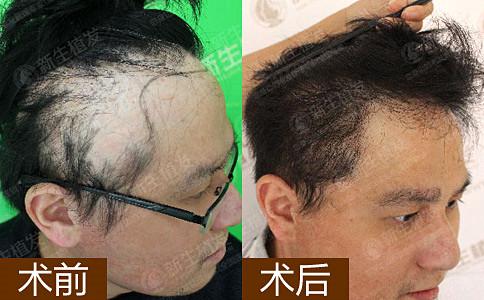 杭州新生植发疤种植案例图片展示