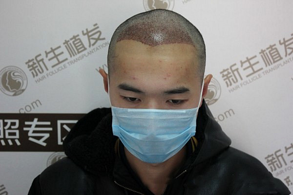 治疗脱发，就选杭州新生植发！