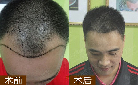 在南京如何让植发效果较好？