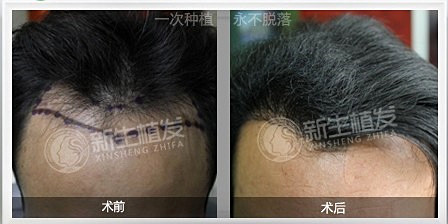 在杭州植发会有后遗症吗