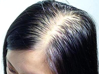 女性头顶稀疏加密植发要注意哪些？