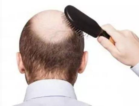 男性植发多久能带假发