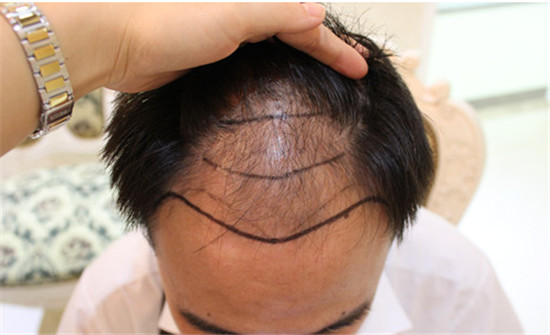 植发前后的对比效果？植发手术注意事项