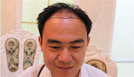植发前后的对比效果？植发手术注意事项
