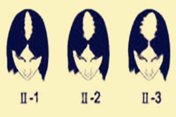 女性植发一般多少单位