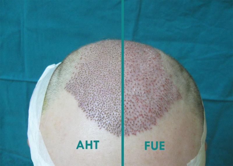 植发手术会导致取发区头发脱落吗
