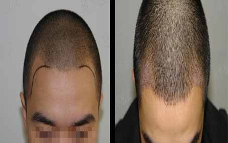 什么是fue自体毛发种植手术，哪些人适合自体毛发移植？