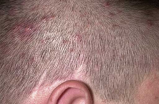秃顶植发副作用，秃顶植发有什么危害