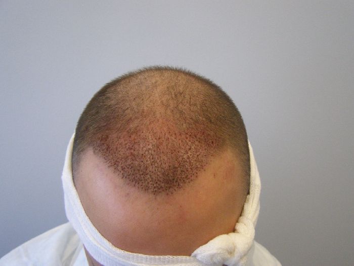 男性植发多久能戴假发