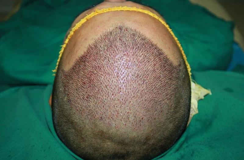 植发恢复期可能出现什么现象？