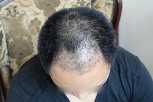植发恢复期可能出现什么现象？