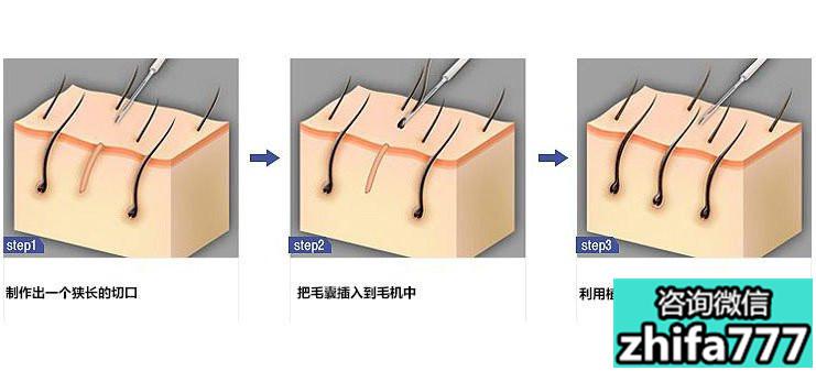 毛发移植的技术设备怎么样？