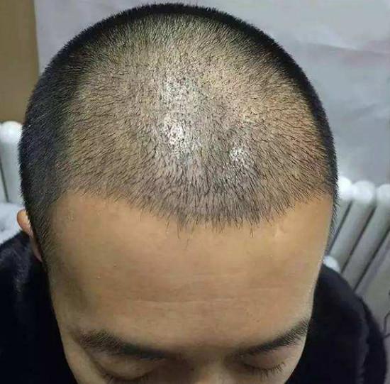 植发手术可以治疗头部疤痕吗 效果如何