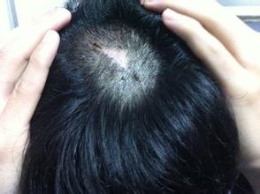 疤痕植发手术的步骤解析，让你了解疤痕植发手术！