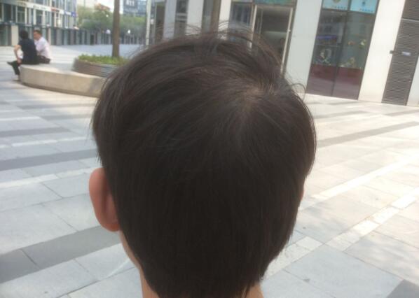 在北京做的植发，术后效果很明显啊