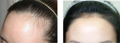 女性植发需要多久有效果