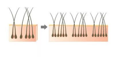 植发手术提取后枕部的毛囊进行植发，为什么呢？