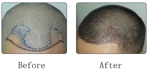 一般的植发后需要多长时间才能长出来呢？植发的恢复过程如何？
