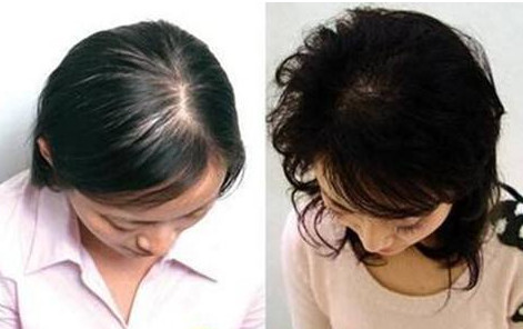 头发加密手术需要多长时间？恢复期又需要多长时间？