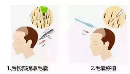 毛发种植手术的4种方法，你了解吗？
