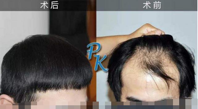 男性头发能种植吗？头发种植能永久有效吗？