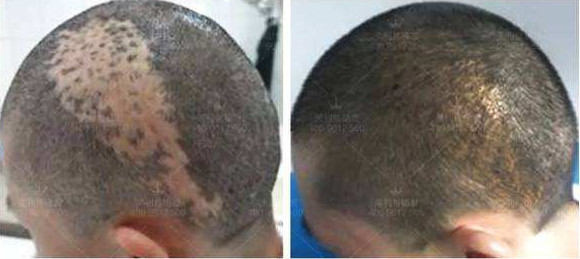 头上有疤痕可以做植发吗，疤痕植发的效果怎么样