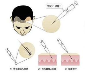 毛发移植有哪些后遗症