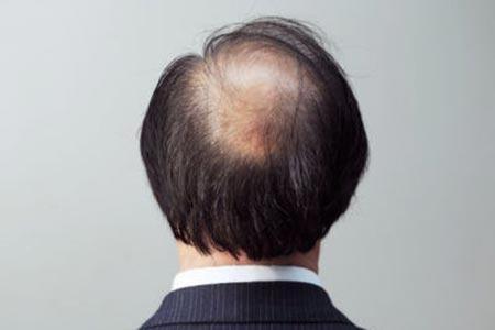 武汉植发告诉你为什么男性脱发更严重