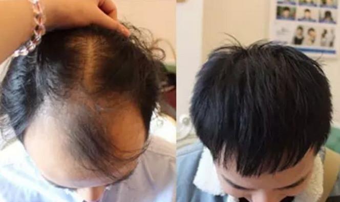 毛发移植效果如何？