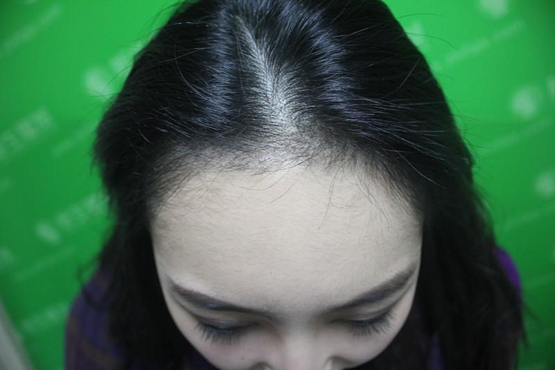 发际线植发的好处 植发后可以保持多长时间？