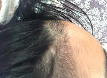 植发后的脱落期一般会持续多久