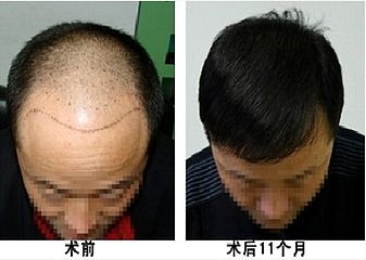 杭州好的植发医院头发加密效果如何