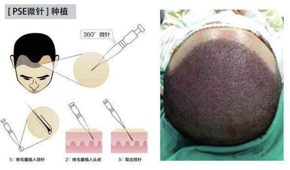 什么是微针植发，有啥优缺点