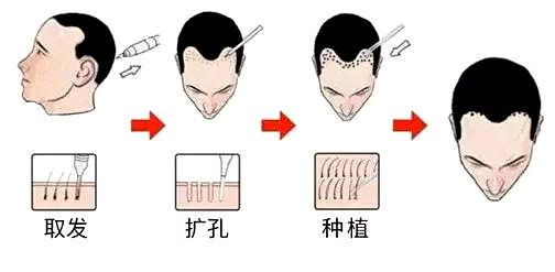 哪些人群适合做植发手术