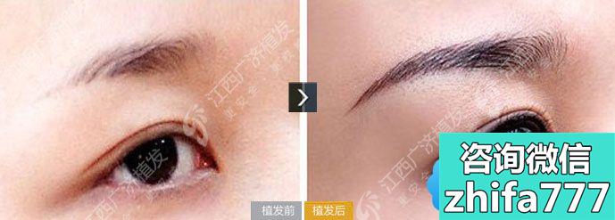 江西广济医院毛发移植案例 女性半截眉种植效果