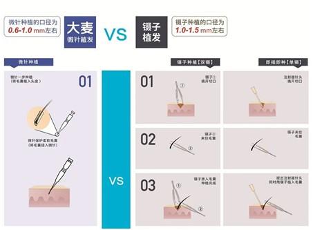 大麦微针植发告诉您 种植笔才是真微针
