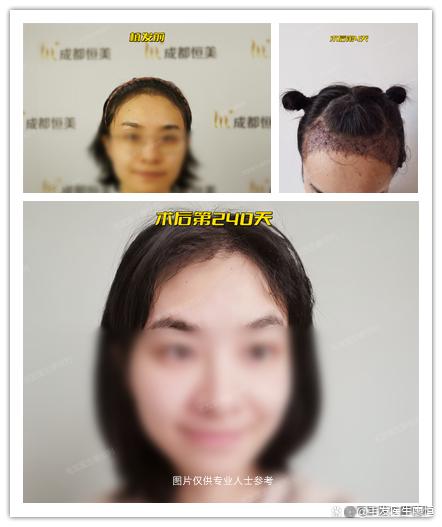 为什么秃顶的人这么多却很少有植发的？