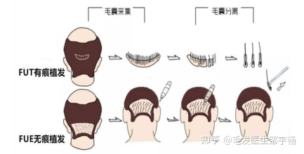 发际线太高，植发真的可行吗？