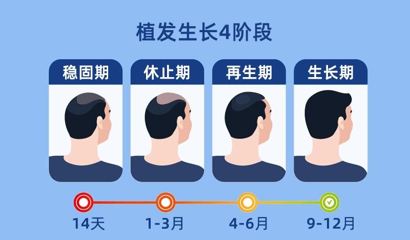 植发后，多久能长出新发？多久能看到效果？