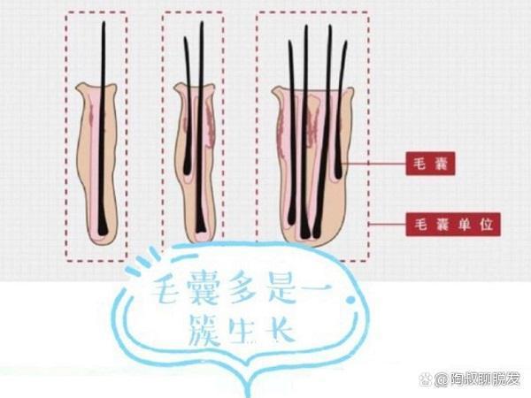 植发种植1000个毛囊单位，能长1000根头发吗？