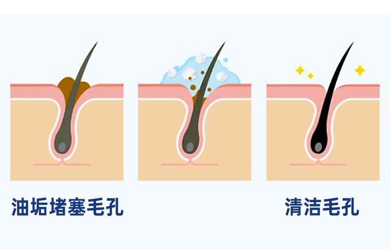 植发后头皮屑特别多，应该怎么办？