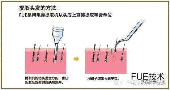 FUT、FUE、微针、熙朵植发技术有什么区别及优缺点对比