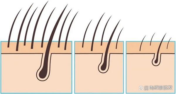 植发后，脱发又来报到，你的头发经历脱落期了吗？